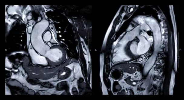 IRM cardiaque